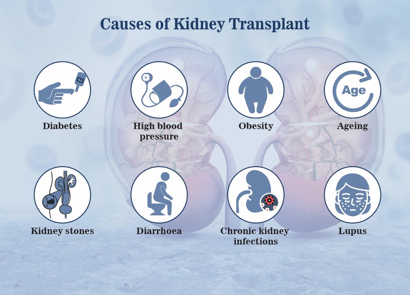 Illustration of Kidney Transplant Surgery